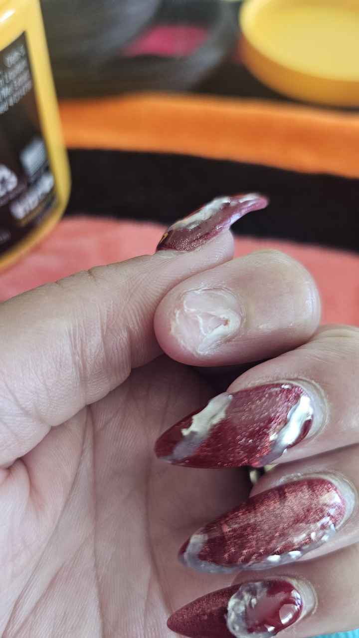 My Finger Nail Fell Off 1 Month Before my Wedding!!! - 4