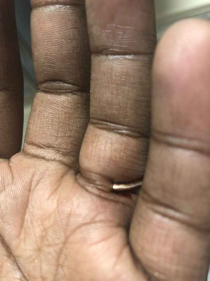 Engagement ring stuck emergency - 1