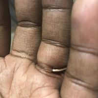 Engagement ring stuck emergency - 1