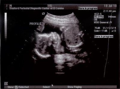 NWR: (BR) 20 wk Ultrasound today...