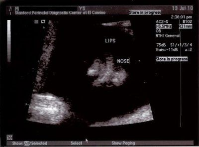 NWR: (BR) 20 wk Ultrasound today...