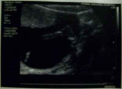 No I am NOT pregnant :)