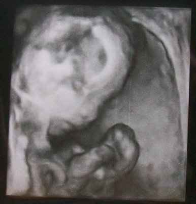 BR- UPDATE: My daughters Ultrasound PICS