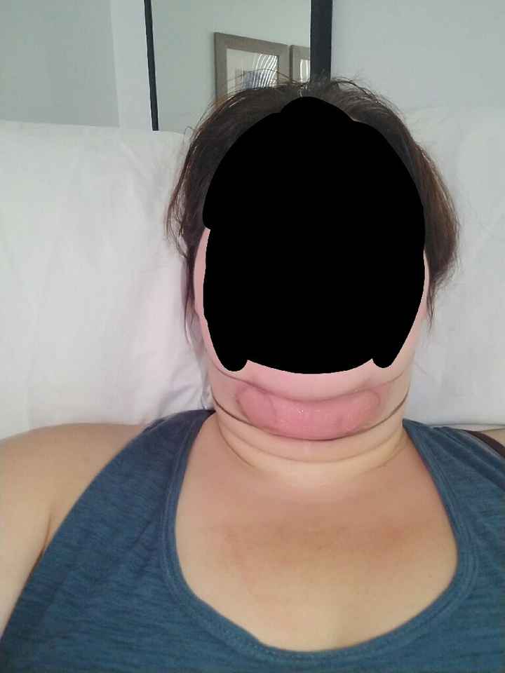 Getting "work done" for the wedding? Coolsculpting - 2