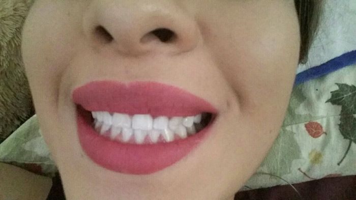 Zoom Whitening