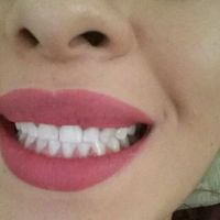 Zoom Whitening