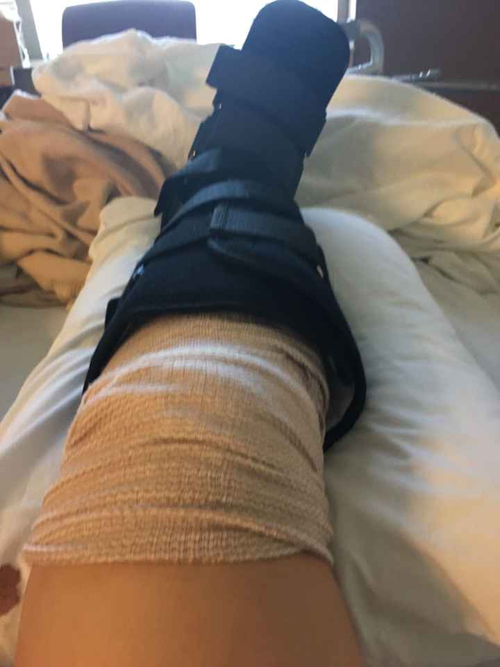 Wedding Fit with broken leg!