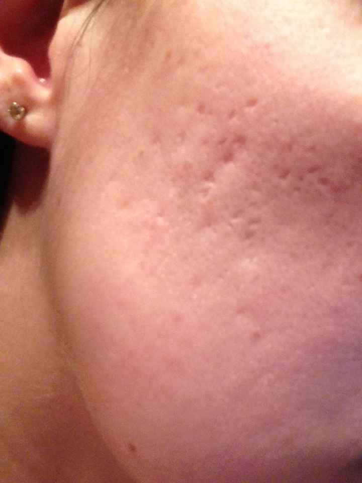 NWR: Fixing Acne Scarring