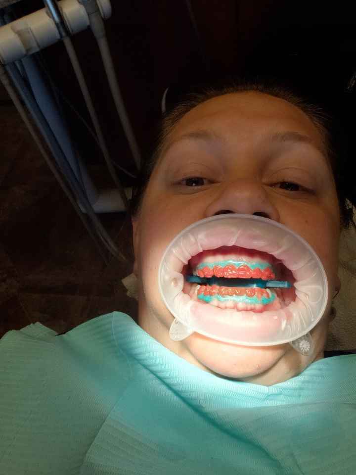 Teeth Whitening - 1