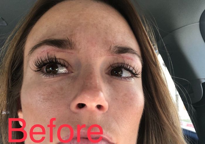 Help! Eyebrow wax burns and wedding is in 4 days! 2