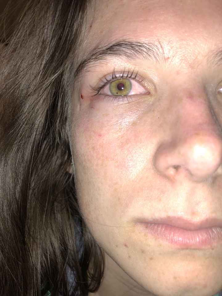 33 days out and i have myself a black eye. 🤦‍♀️ - 1