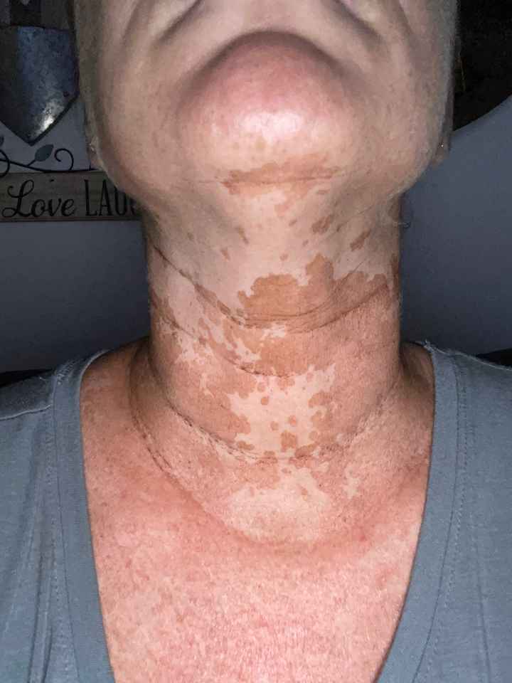 Tinea Versicolor... - 1