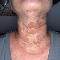 Tinea Versicolor... - 1