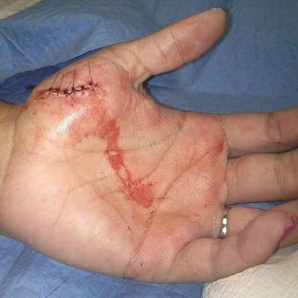 11 Days Out and I had to get stitches :( *Warning slightly graphic pic included*