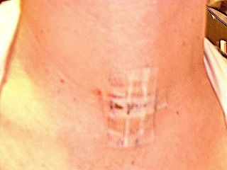 NWR- did anyone have or know anyone with Parathyroid?