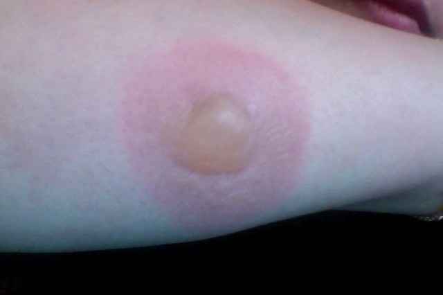 I burned the shit out of my arm!