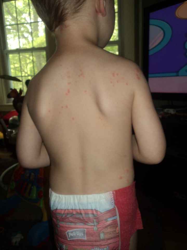 NWR - Flea bites vs. bed bugs..