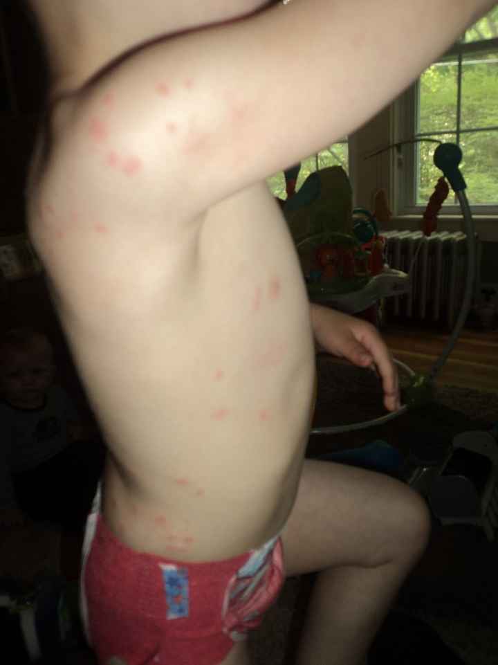 NWR - Flea bites vs. bed bugs..