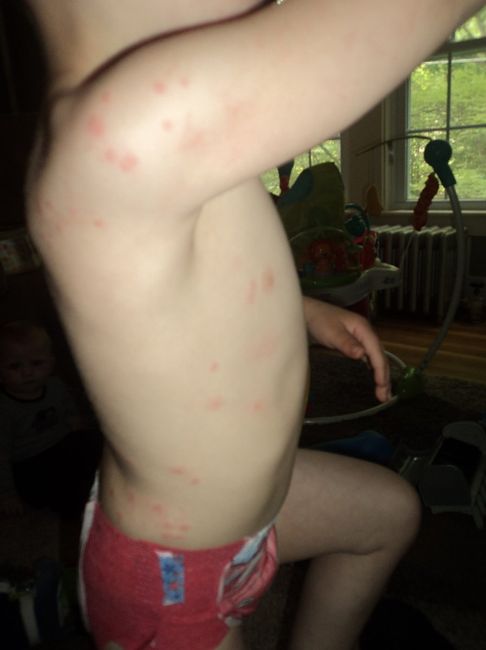 NWR - Flea bites vs. bed bugs..