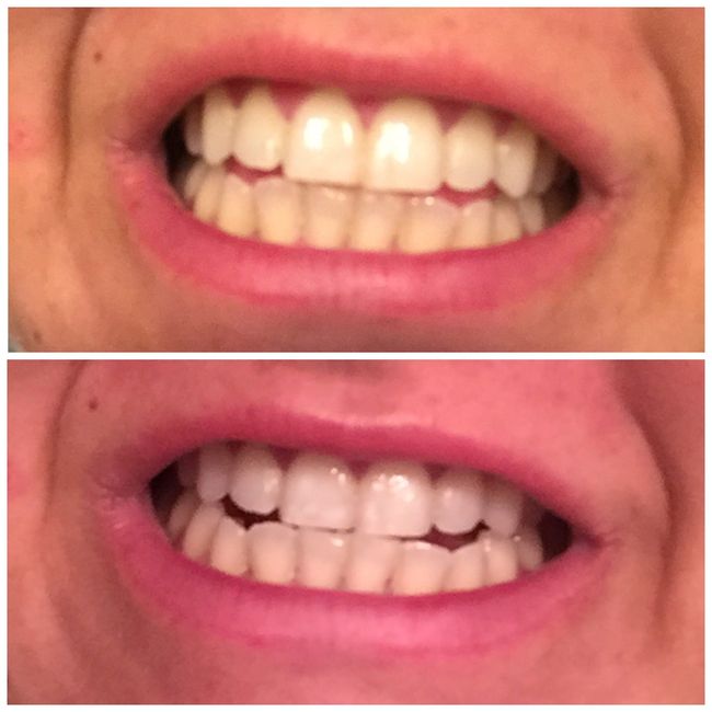 Prime Day Teeth Whitening