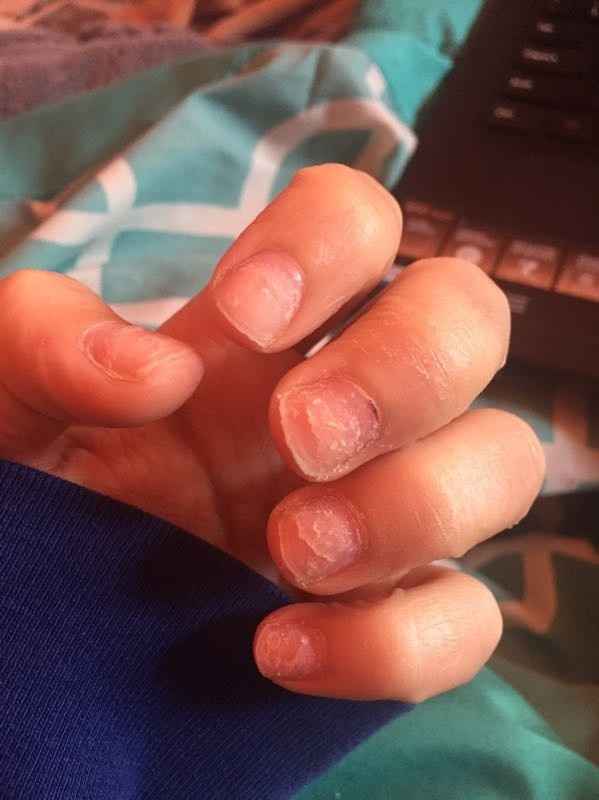 SOS: I tried to take off my own fake nails.