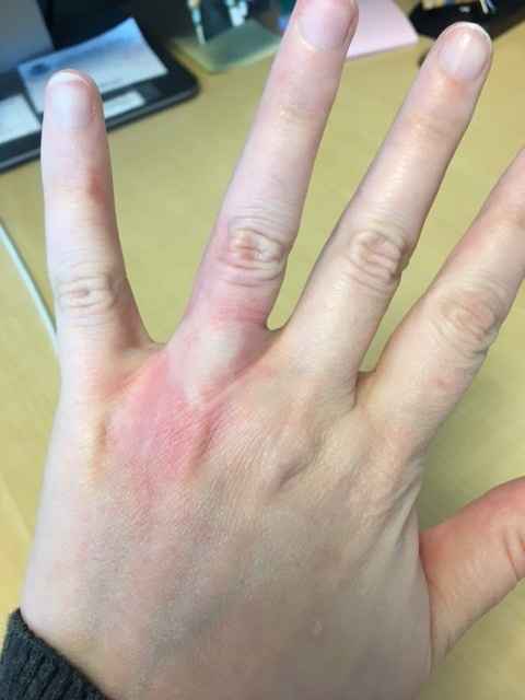 Allergic to ring 6 months later?