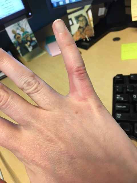 Allergic to ring 6 months later?