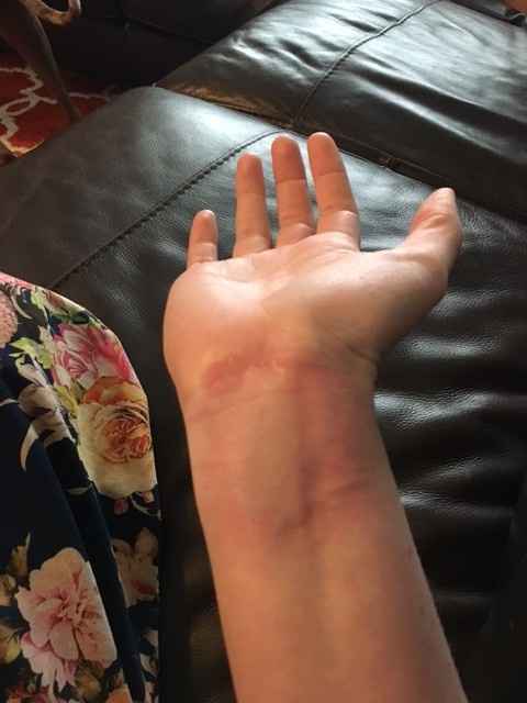 Allergic to ring 6 months later?