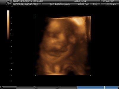 4D Ultrasound (Pic Heavy) NWR