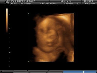 4D Ultrasound (Pic Heavy) NWR