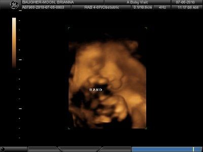 4D Ultrasound (Pic Heavy) NWR