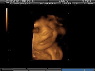 4D Ultrasound (Pic Heavy) NWR