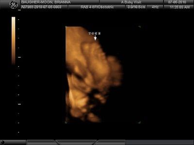 4D Ultrasound (Pic Heavy) NWR