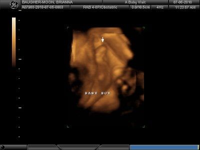 4D Ultrasound (Pic Heavy) NWR
