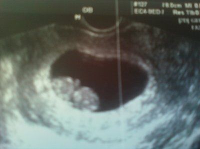 BR:  14 week ultrasound!