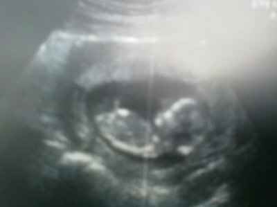 BR:  14 week ultrasound!
