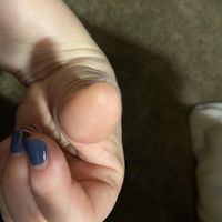 Glue gun burn…on ring finger! :( - 1