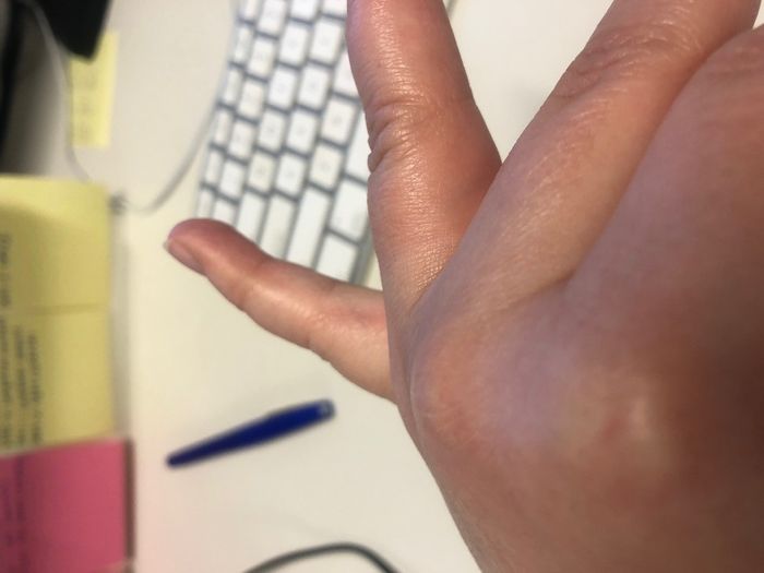 Finger Swollen After Getting Engaged 2