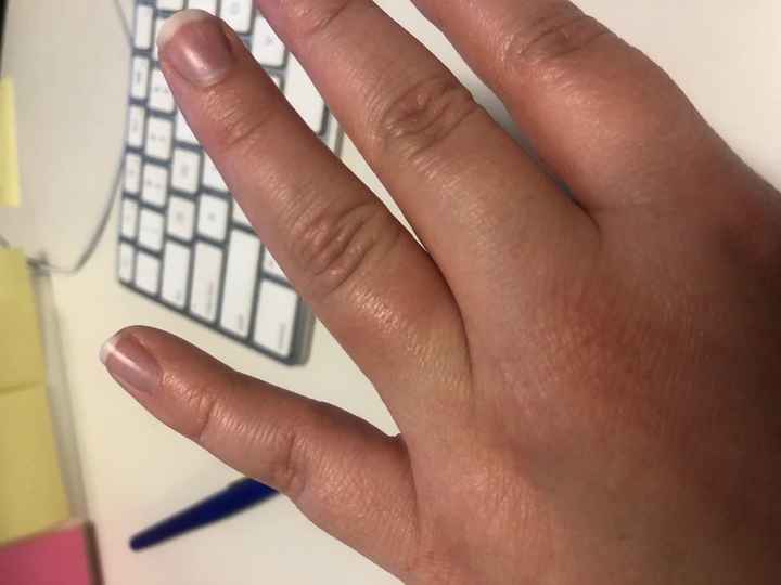 You can see that where the ring actually sits is not red or swollen.