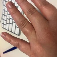 You can see that where the ring actually sits is not red or swollen.