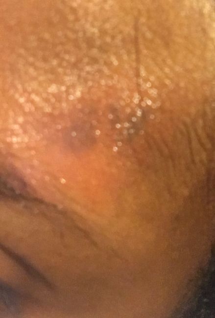  Burned before wedding - 1