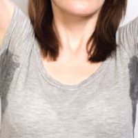 MiraDry..... Anyone Have Experience With This Procedure?