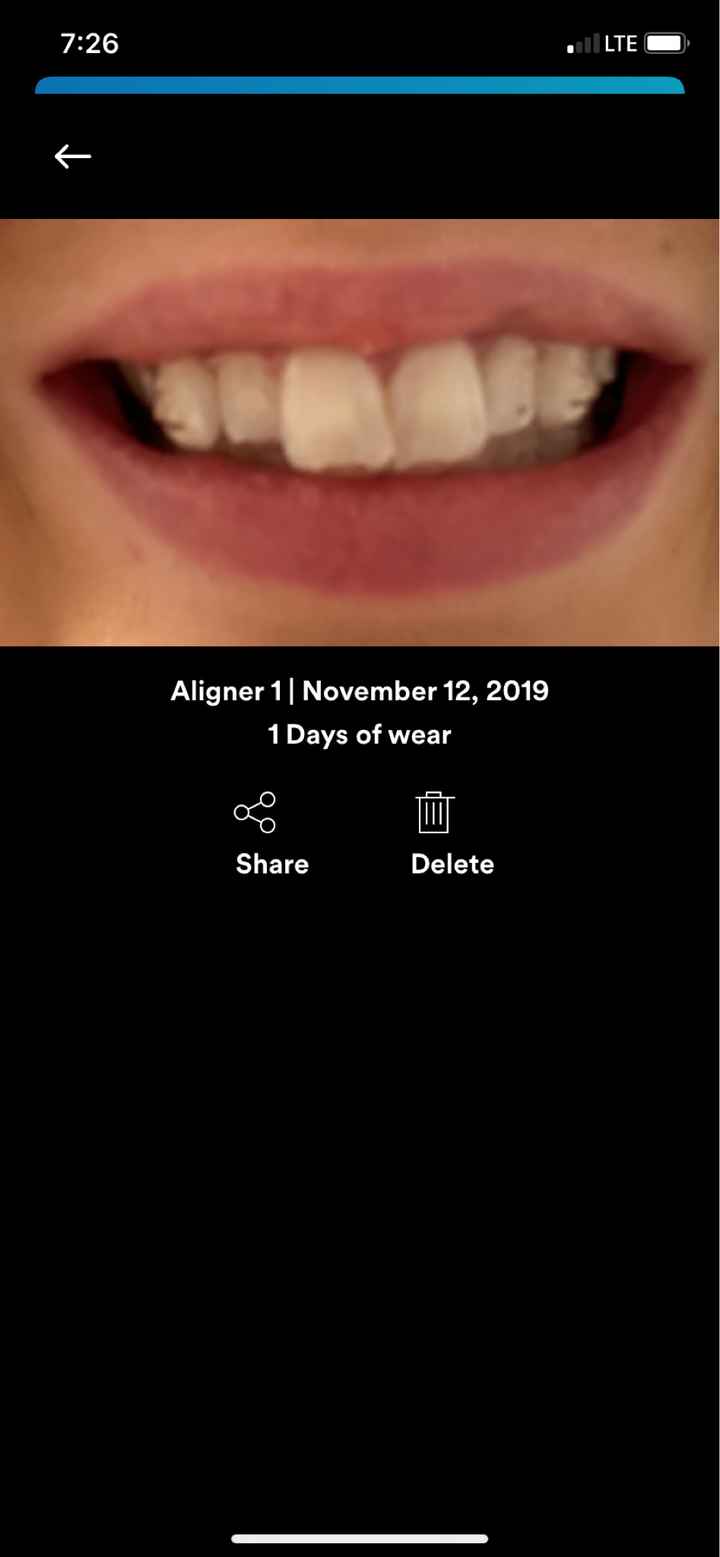Invisalign - 1