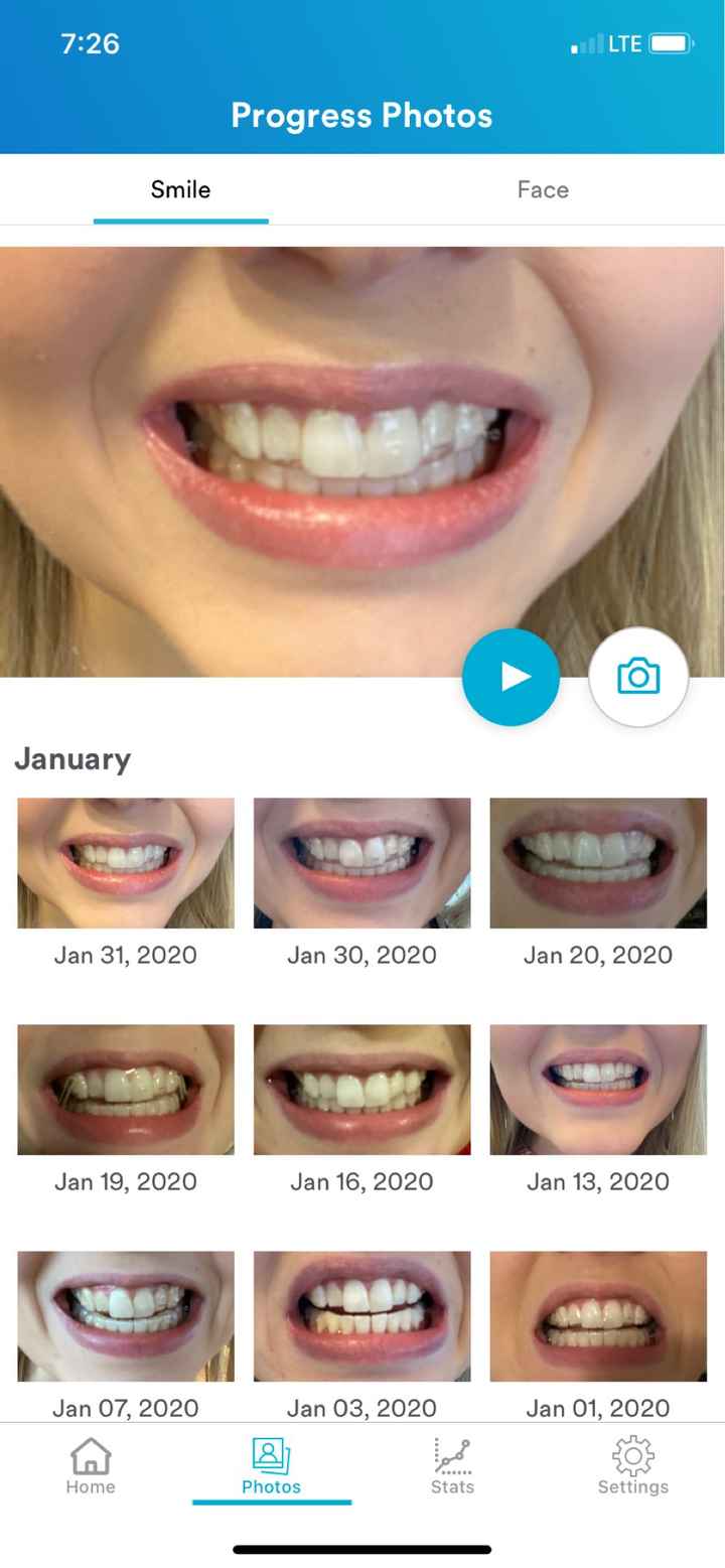 Invisalign - 2