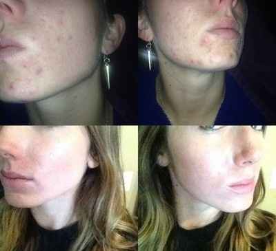 Skin Journey  &  need cosmetology procedure advice
