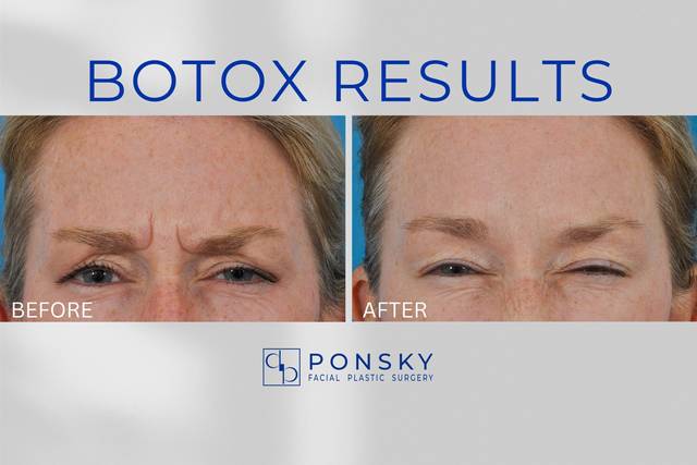 Botox Results