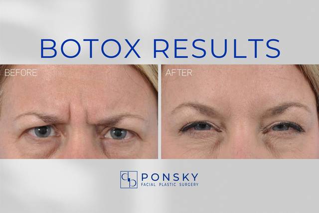 Botox Results
