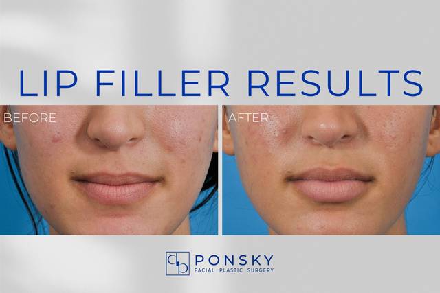 Lip Filler Results