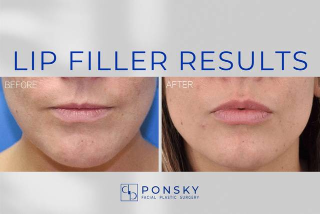 Lip Filler Results