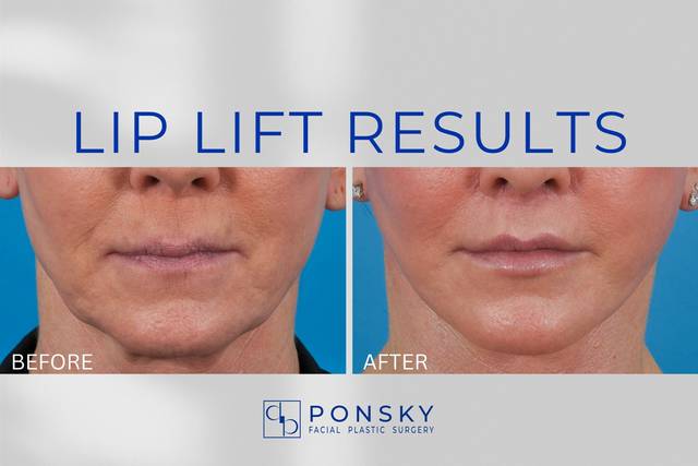 Lip Lift Results